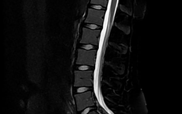 Lumbar MRI Magnetic Resonance Imaging