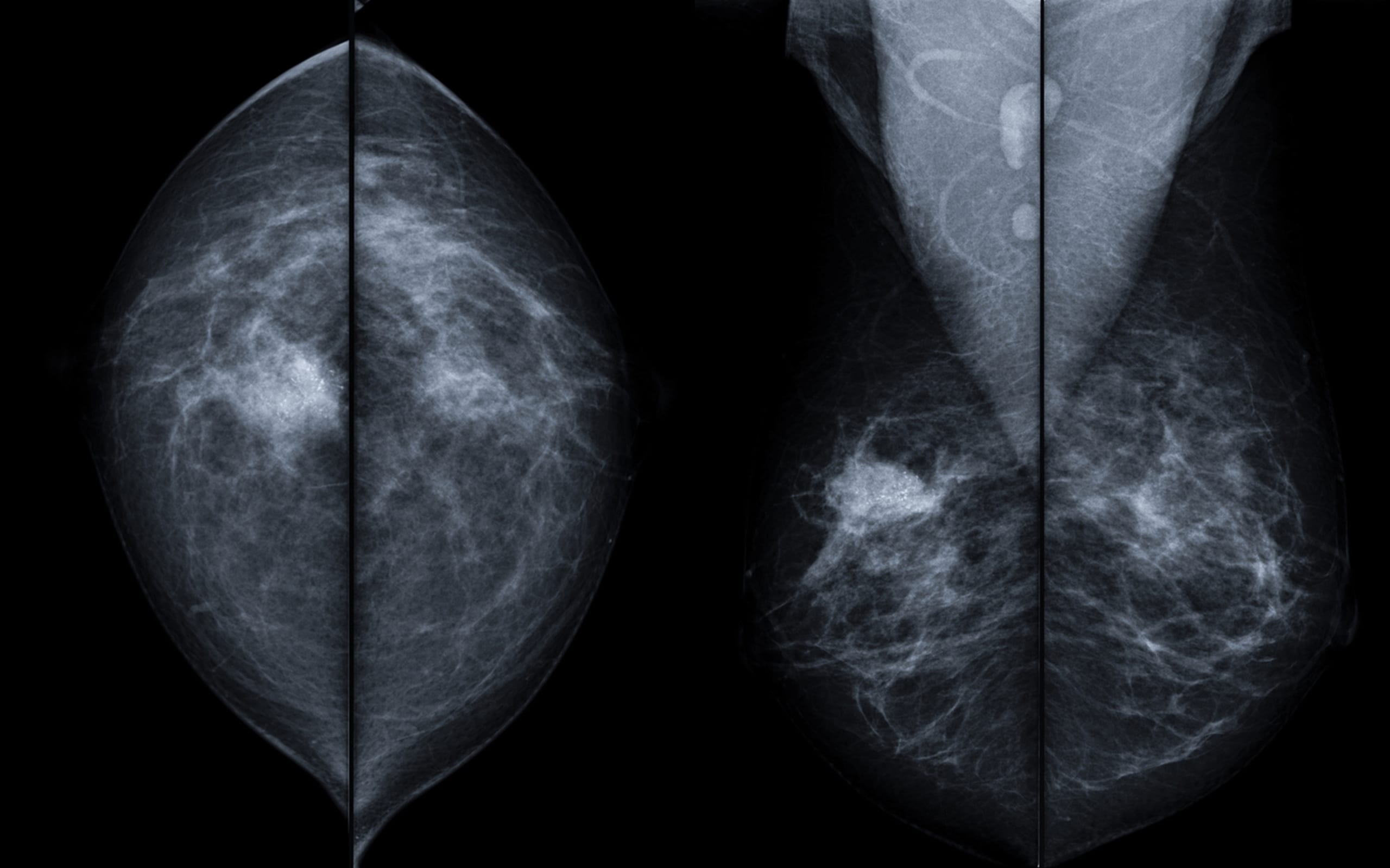 Breast Cancer Prevention Radiology Of Indiana