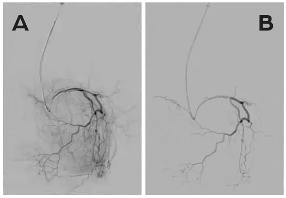 Genicular Artery Embolization BEFORE AND AFTER