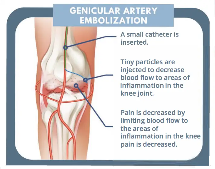 Genicular Artery Embolization procedure