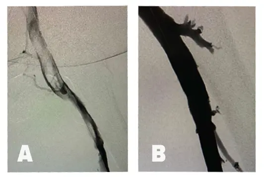 Deep Vein Thrombosis (DVT)