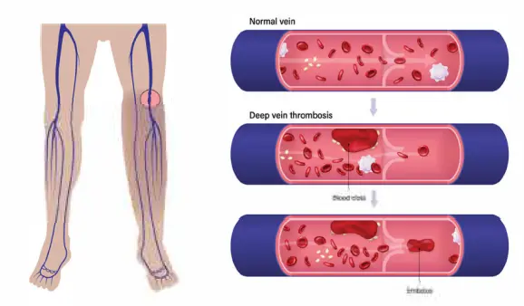 Deep Vein Thrombosis (DVT)